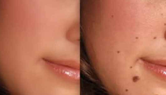 how to remove moles