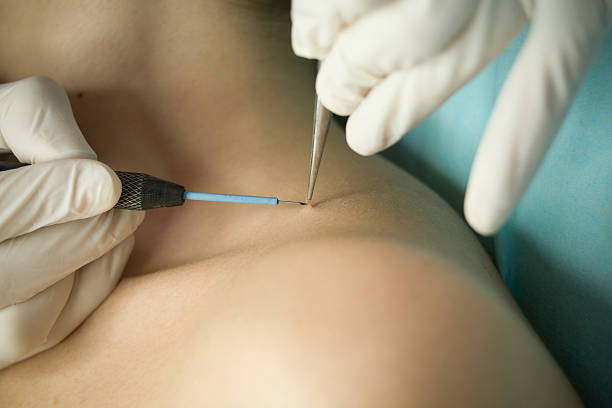 wart treatment Long Beach CA