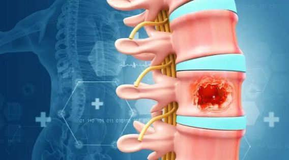 Spine Tumor Surgery in India: Meet the Top Spine Specialist in India