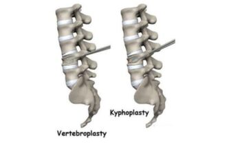 Vertebroplasty and Kyphoplasty Recovery Time in the Elderly: Consult a Top Spine Surgeon in India, Kolkata