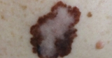 Treat Wrinkles and Warts in Orange, CA: A Guide to Coastal Dermatology & Plastic Surgery