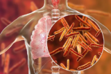 Advancement in TB drug discovery